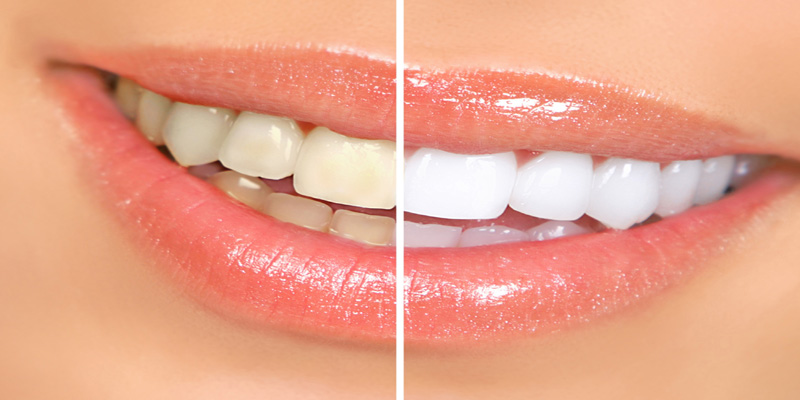 Tooth Bleaching at PERFECT SMILE